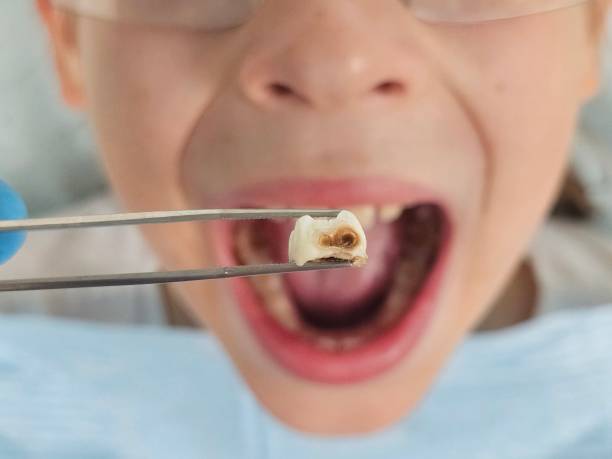 Best Emergency Root Canal Treatment in Warren Park, IN